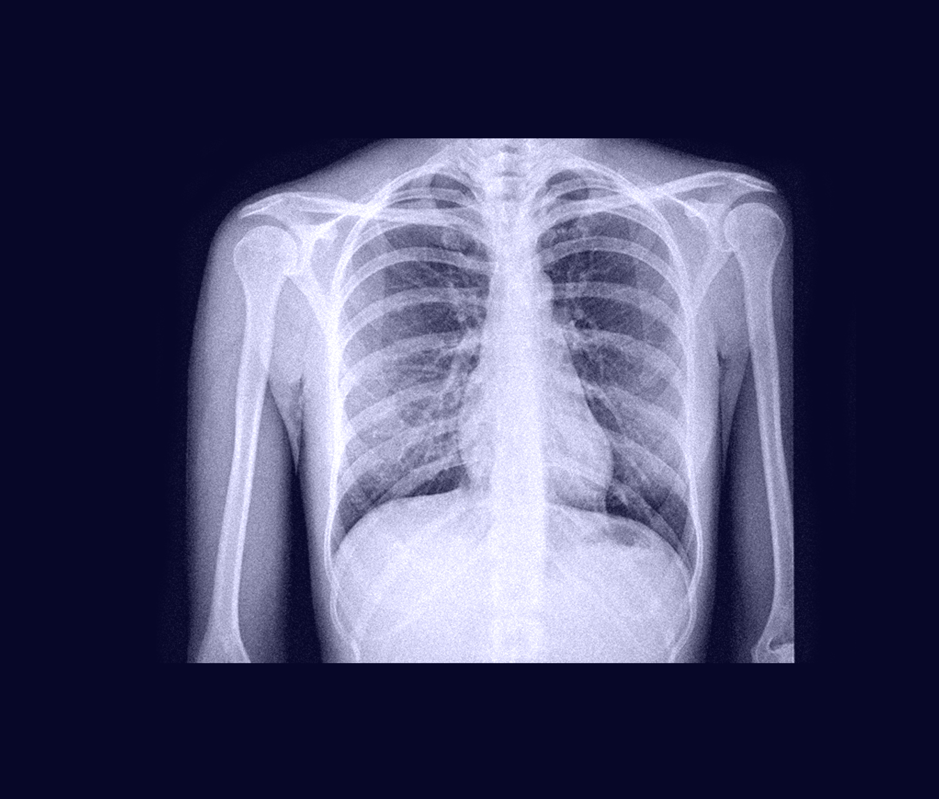 Chest displaying ribs radiography