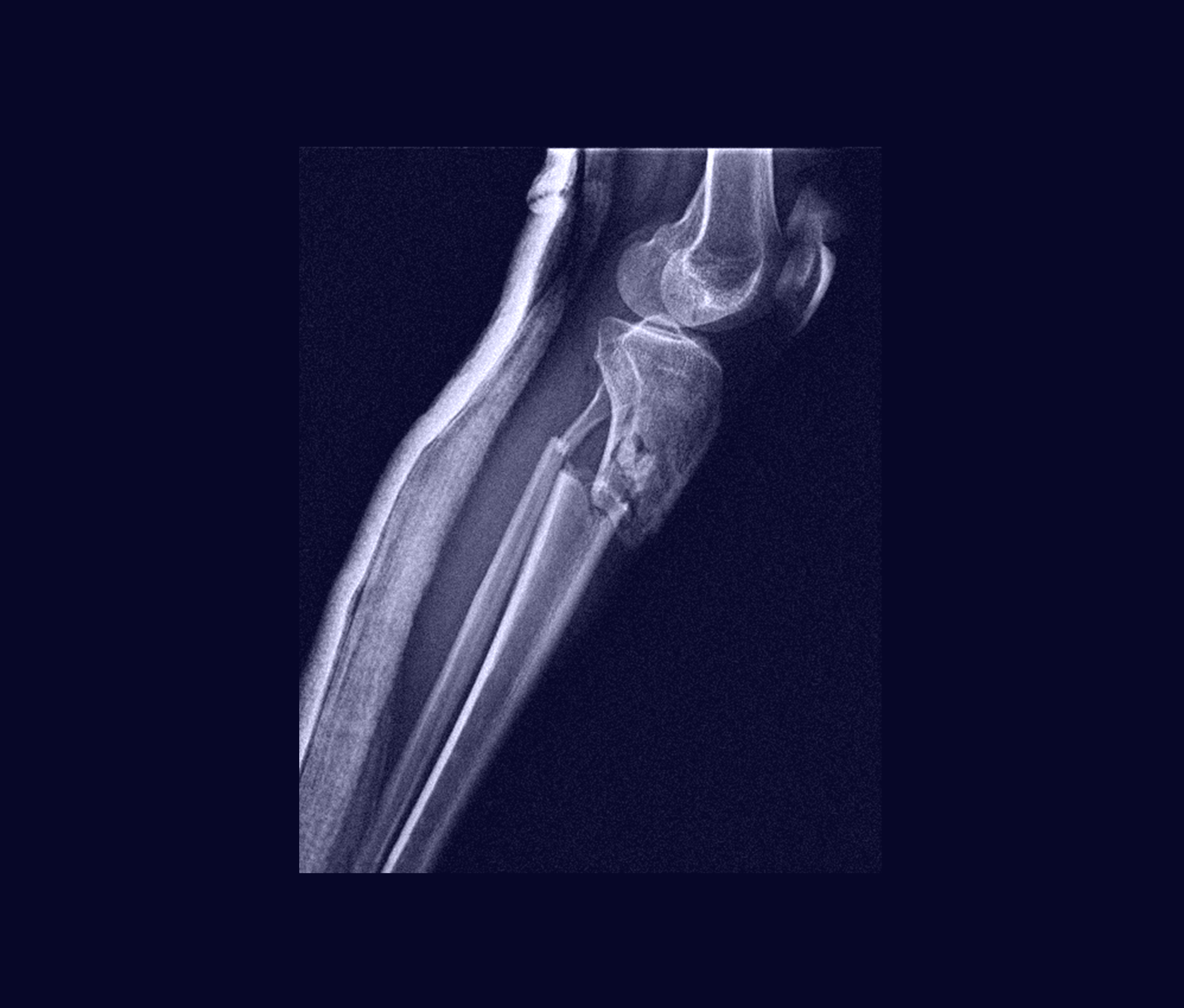 Bone blue radiography 