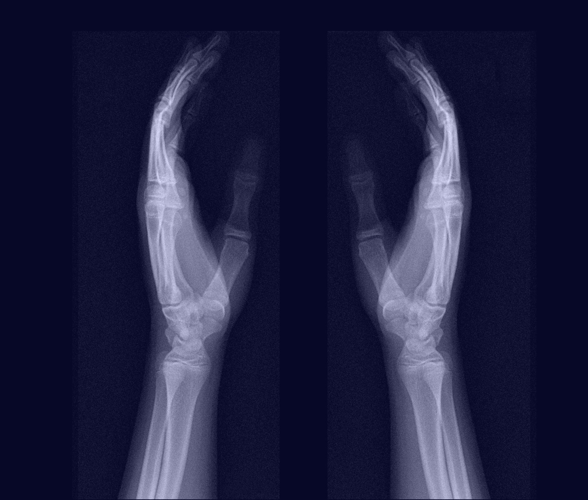 hand bones blue radiography