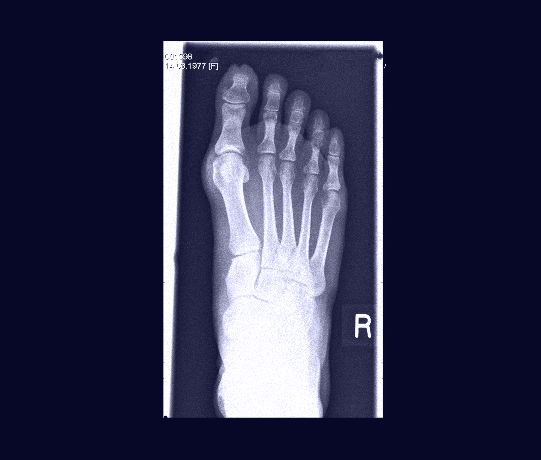 Feet radiography scan 
