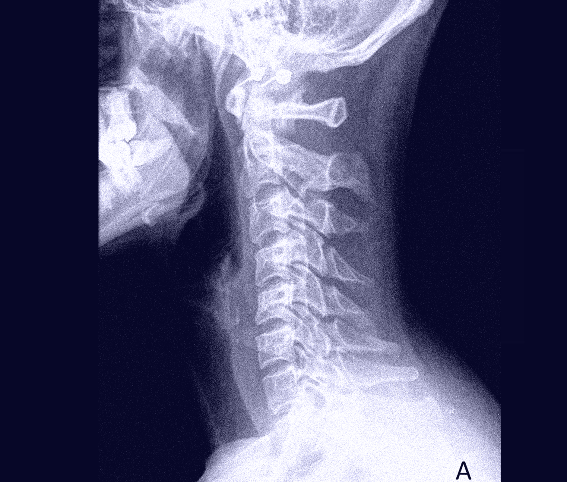 Nape radiography scan 