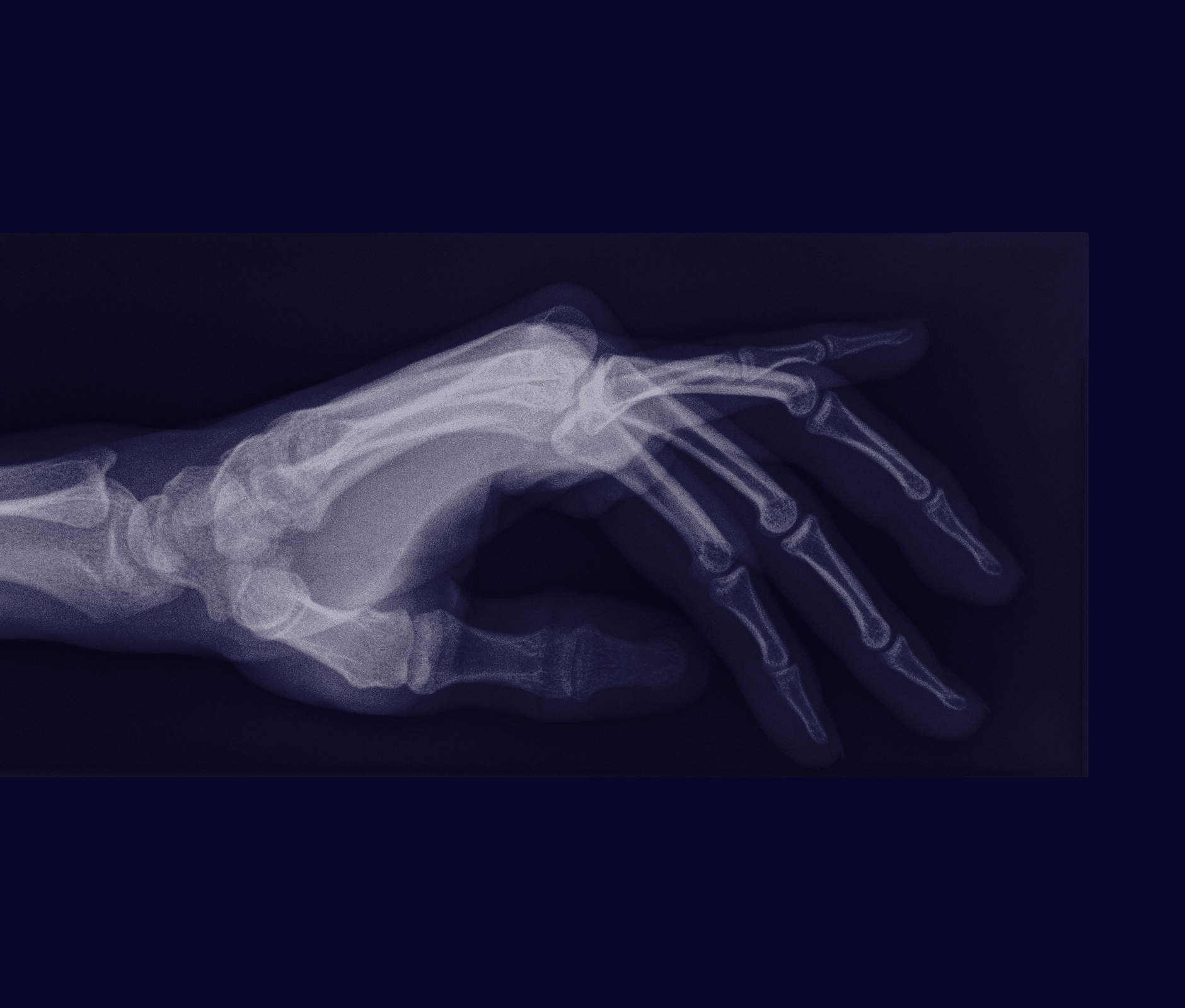 Hand radiography in blue